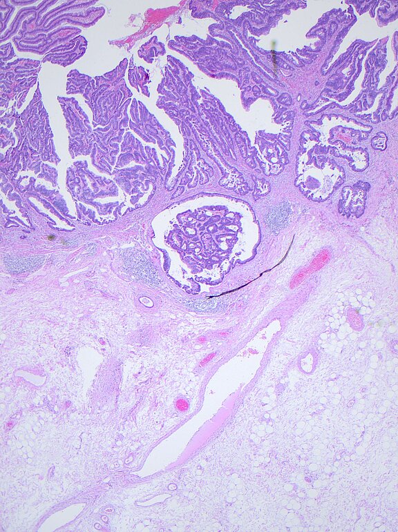 Mikroskopische Aufnahme von Gewebe, das in lila und rosa Tönen gefärbt ist. Die Struktur zeigt Drüsen und Zellen, die in verschiedenen Anordnungen angeordnet sind, sowie eine klare Abgrenzung zwischen den unterschiedlichen Gewebearten.