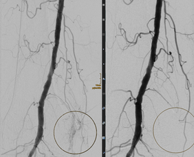 Die Abbildung zeigt zwei kontrastierte Darstellungen eines Blutgefäßes. Links ist ein normaler Verlauf zu sehen, während rechts eine Anomalie in einem hervorgehobenen Bereich erkennbar ist. Die Umrandungen in beiden Bildern zeigen spezifische Details der Gefäßstruktur.