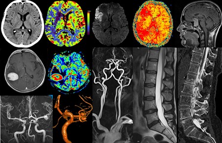 Die Abbildung zeigt verschiedene medizinische Bildgebungen des Gehirns und der Wirbelsäule, einschließlich CT-Scans, MRT-Bildern und farbcodierten Darstellungen von Blutgefäßen. Diese Bilder sind zur Analyse von neurologischen und vaskulären Erkrankungen geeignet.