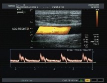 Das Bild zeigt ein Ultraschallbild mit einem gelben Bereich, der vermutlich ein Blutgefäß darstellt. Darunter ist ein Diagramm mit Wellenformen, das die Blutflussgeschwindigkeit oder -dynamik anzeigt. Es handelt sich um medizinische Diagnosedaten zur Beurteilung der Gefäßgesundheit.